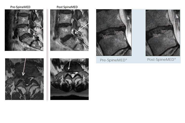 pre-spined-med-vs-post-spined-med