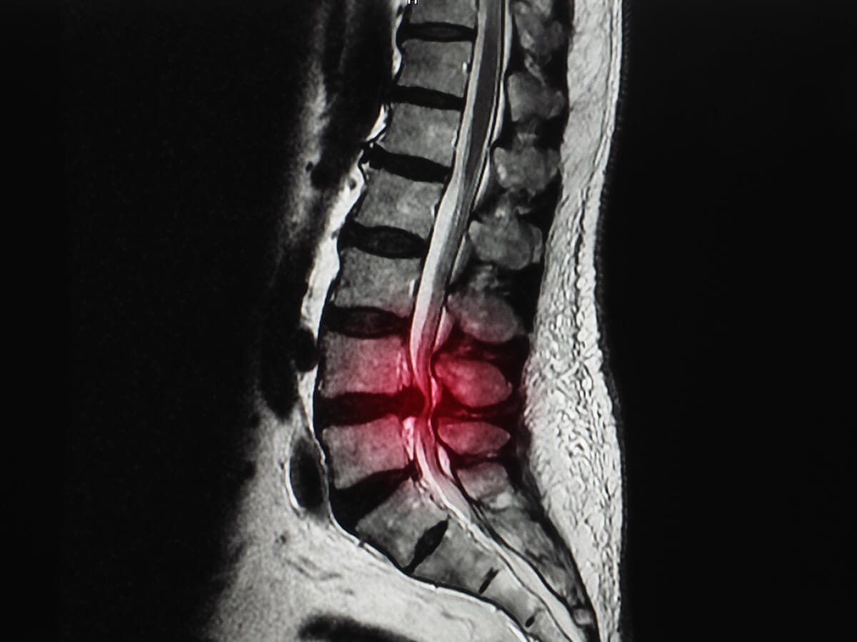 Why Many People Want to Avoid Back Surgery