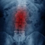 Disc Degenerative Disease — Misconceptions and Treatment Options