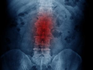 Disc Degenerative Disease — Misconceptions and Treatment Options