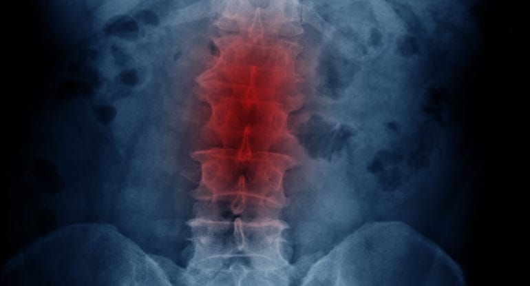 Disc Degenerative Disease — Misconceptions and Treatment Options