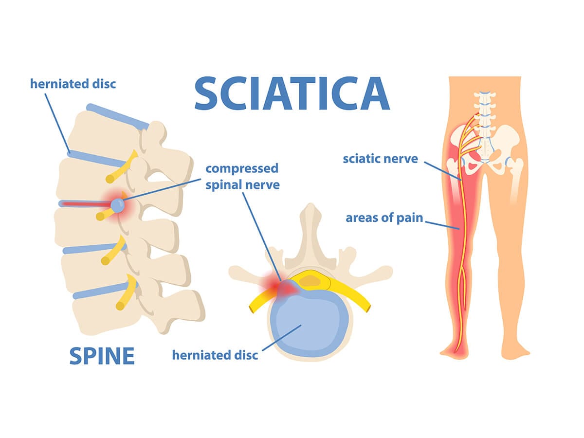 How a Herniated Disc Heals (The Science in Plain English)