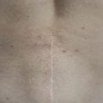 How to Avoid Back Surgery With Non-Surgical Spinal Decompression Therapy