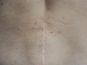 How to Avoid Back Surgery With Non-Surgical Spinal Decompression Therapy