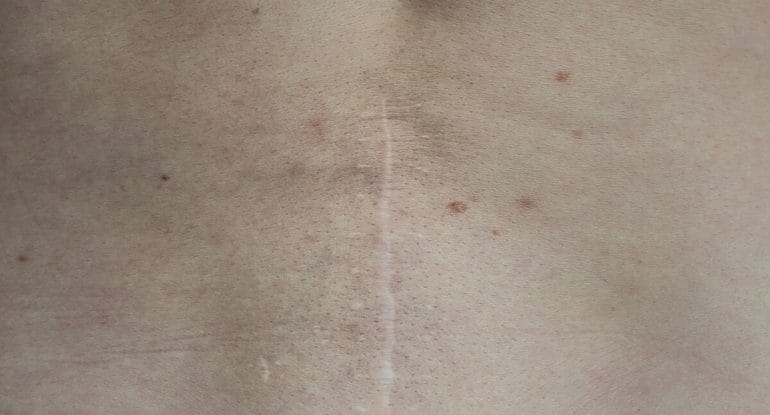 How to Avoid Back Surgery With Non-Surgical Spinal Decompression Therapy