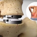 Artificial disc replacement implant shown between spinal vertebrae