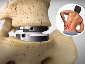 Artificial disc replacement implant shown between spinal vertebrae