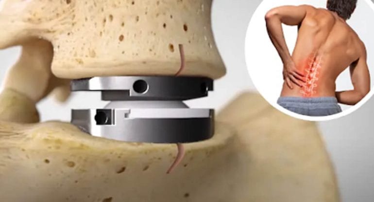 Artificial disc replacement implant shown between spinal vertebrae