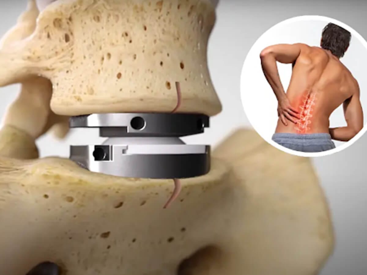 Disc Replacement Surgery Explained: What Patients Should Know Before ...
