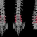 CT scan of the lumbar spine showing postoperative structural changes following spinal surgery, commonly used to assess disc and spinal alignment after intervention.