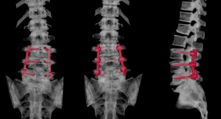 CT scan of the lumbar spine showing postoperative structural changes following spinal surgery, commonly used to assess disc and spinal alignment after intervention.